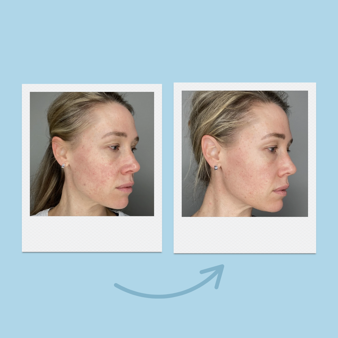 Liquid Microneedling + Copper Peptides Face Serum